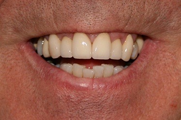 Healthy smile after dental crowns