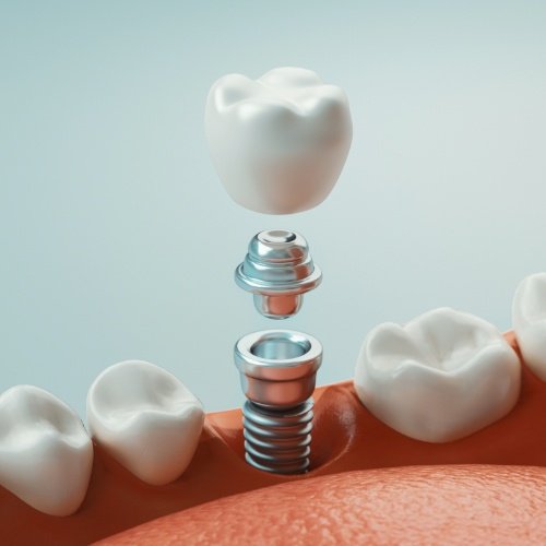 Animated smile with dental implant being placed