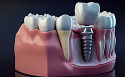 Dental implant surgery