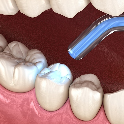 Animated smile during cosmetic dental bonding treatment