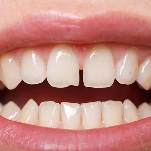 Closeup of smile in need of cosmetic dental bonding treatment