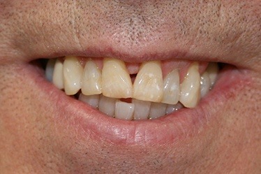 Worn and damaged smile before dental crowns