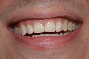 Smile seamlessly repaired with composite resin filling
