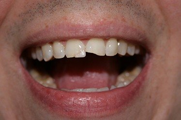 Chipped front tooth before composite resing filling