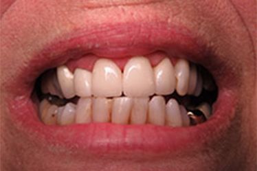 Attractive healthy smile after dental crowns
