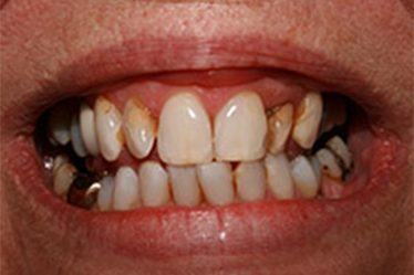 Worn and discolored smile before dental crowns