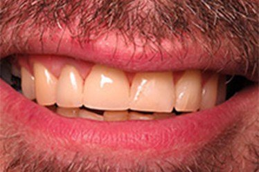Perfect smile after dental implant tooth replacement