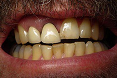 Damaged tooth before repalcement with dental implants