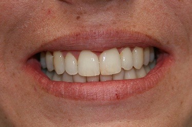 Evenly spaced teeth after braces
