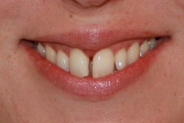 Gap between front teeth before braces