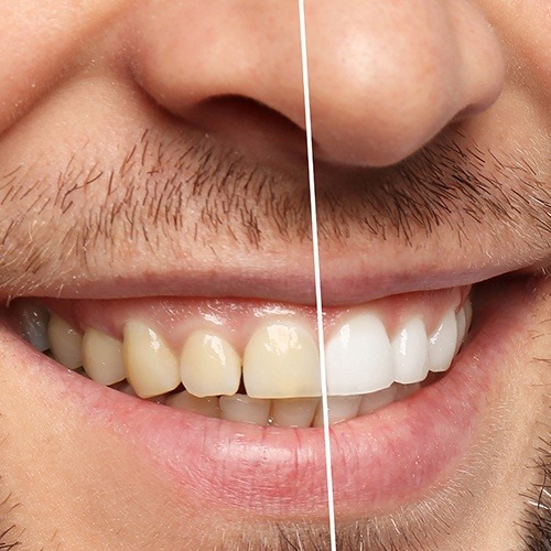 Smile before and after teeth whitening