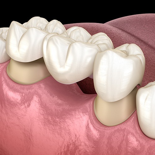 Animated smile during fixed bridge placement