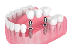Digital illustration of an implant bridge in Lacey