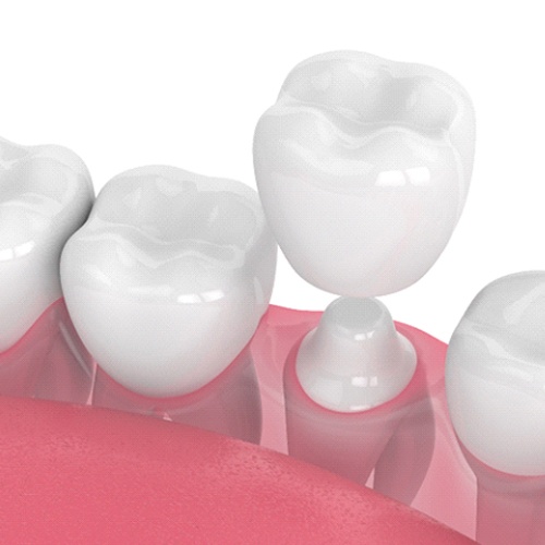 Digital illustration of dental crowns in Lacey