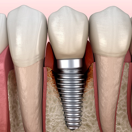 Diagram of a failed dental implant in Lacey