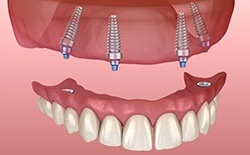 Animated smile during dental implant supported denture placement