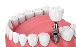 Dental implant in Lacey