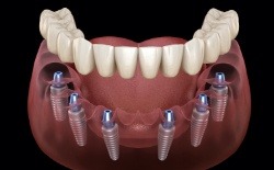 Animated smile during dental implant supported denture placement