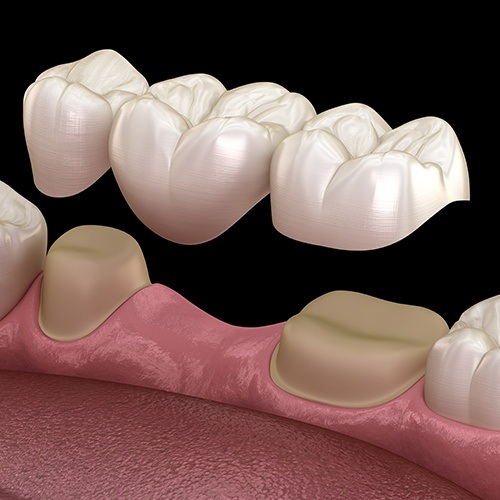 Animated smile during fixed bridge placement to replace missing teeth