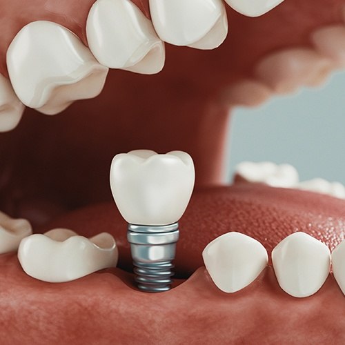 Animated smile during dental implant supported dental crown placement