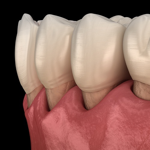Animated smile with soft tissue recession before periodontal therapy for gum disease