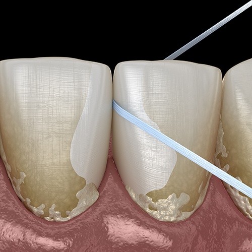 Animated smile during gum disease treatment