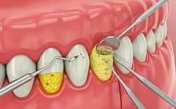 Digital image of dental tools performing scaling