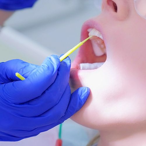 Patient receiving fluoride treatment