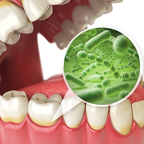 Animated smile with enlarged bacteria representing periodontal therapy