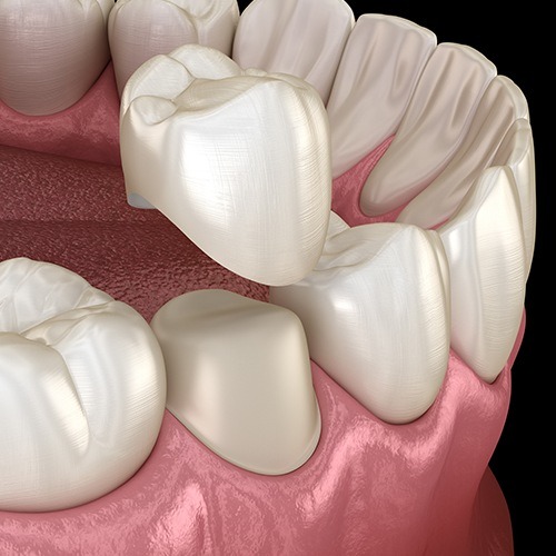 Animated smile during dental crown restorative dentistry treatment