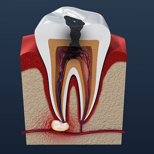 Animated tooth with decay before root canal therapy