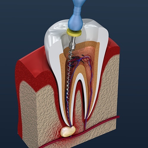 Animated tooth during root canal therapy