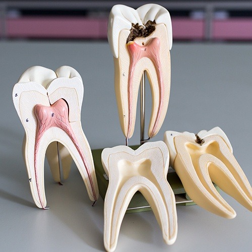 Model of healthy smile compared with smile in need of root canal therapy