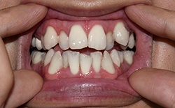 Crowded teeth