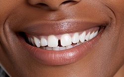 Up-close view of a gap between the upper front two teeth