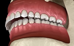 Digital view of an overbite