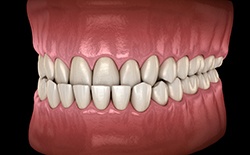 Digital view of an underbite