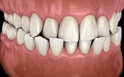Digital view of a crossbite