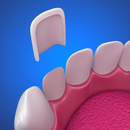 Animated smile during porcelain veneer placement