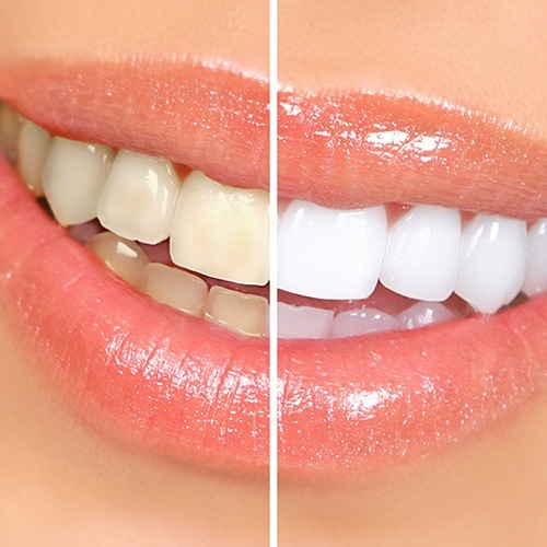 Smile before and after teeth whitening