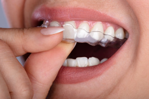 Woman putting in her SureSmile clear aligners