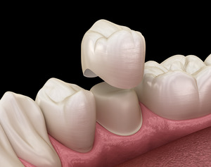 Illustration of crown being placed on a prepared tooth