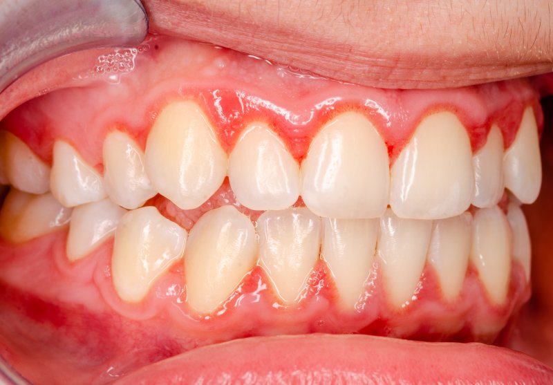 up-close view of serious gum disease