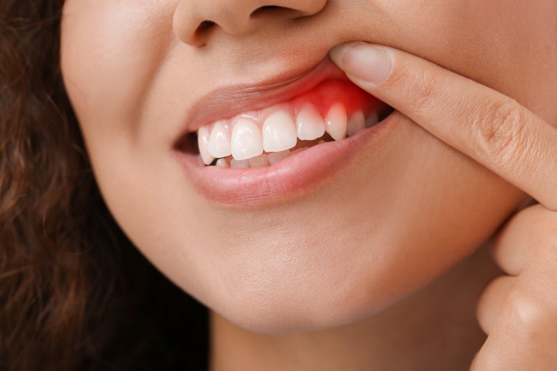woman showing her red and inflamed gum tissues