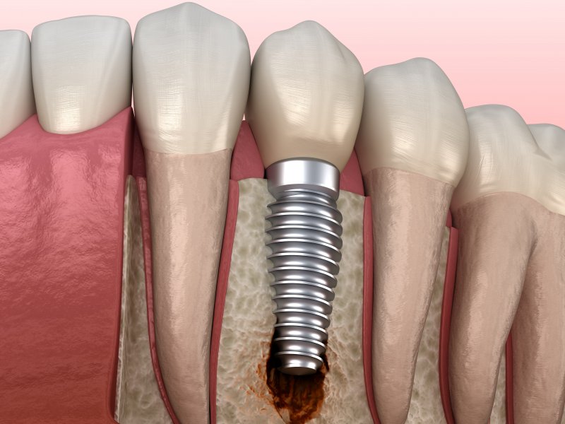 a failed dental implant