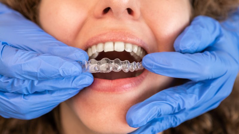 dentist inserting SureSmile aligner into patient's mouth