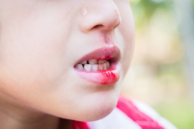 A closeup of a child with a bloody mouth.