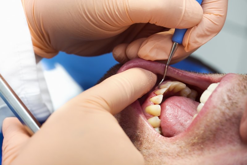 Close-up of dentist performing gum disease treatment in Lacey on male patient