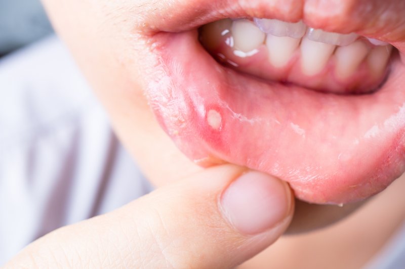 Canker sore on lip