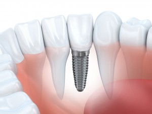 Dental implants in Lacey are the gold standard for artificial teeth – they look great, they can last a lifetime, and they make your jawbone stronger. 